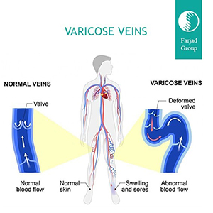 Varicose Veins